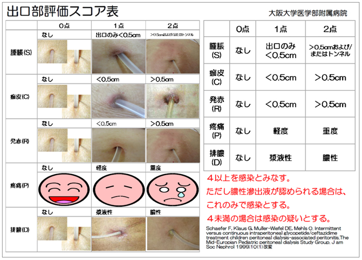 腹膜 透析 バッグ 交換 人気 手順